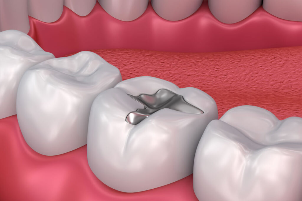 Carlsbad Tooth Filling