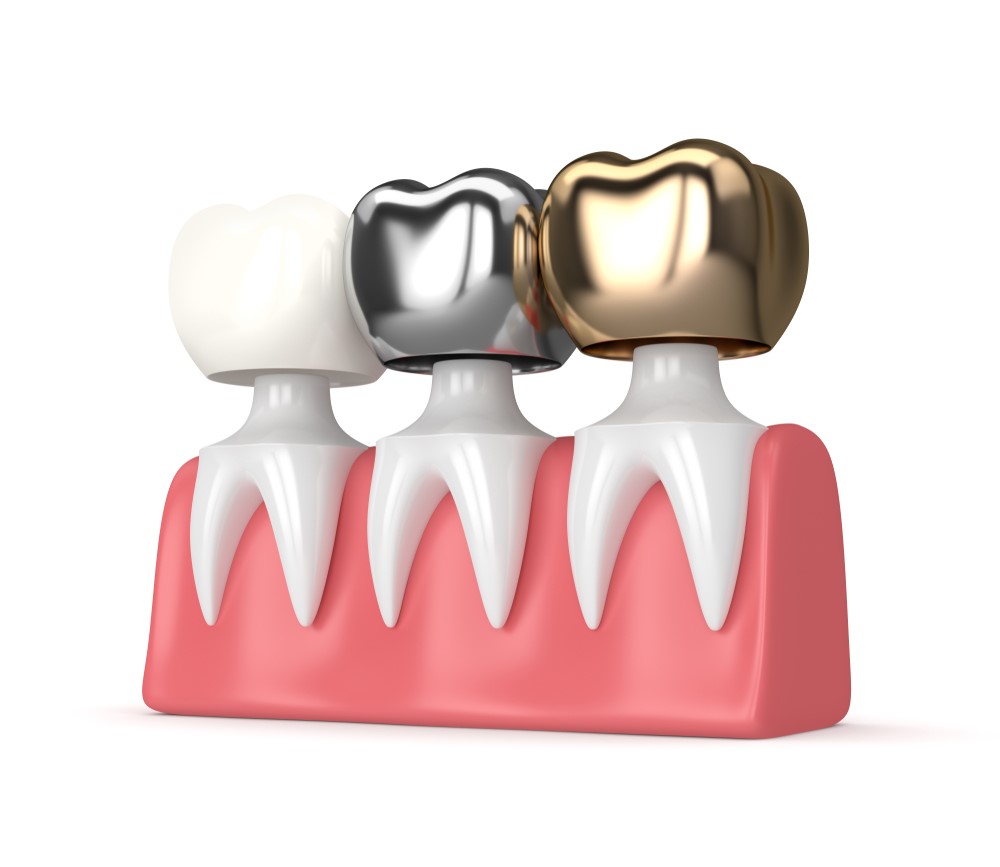 Oceanside Dental Crown