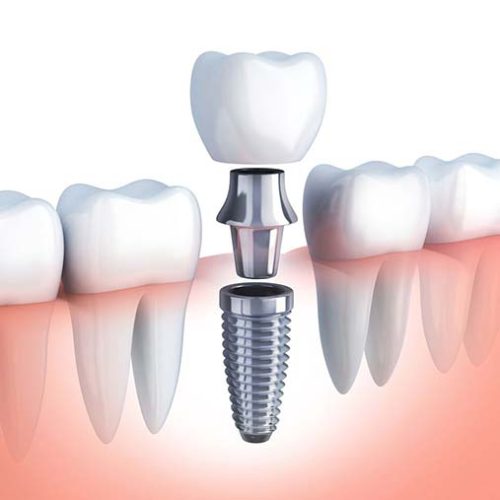Oceanside Dental Implants