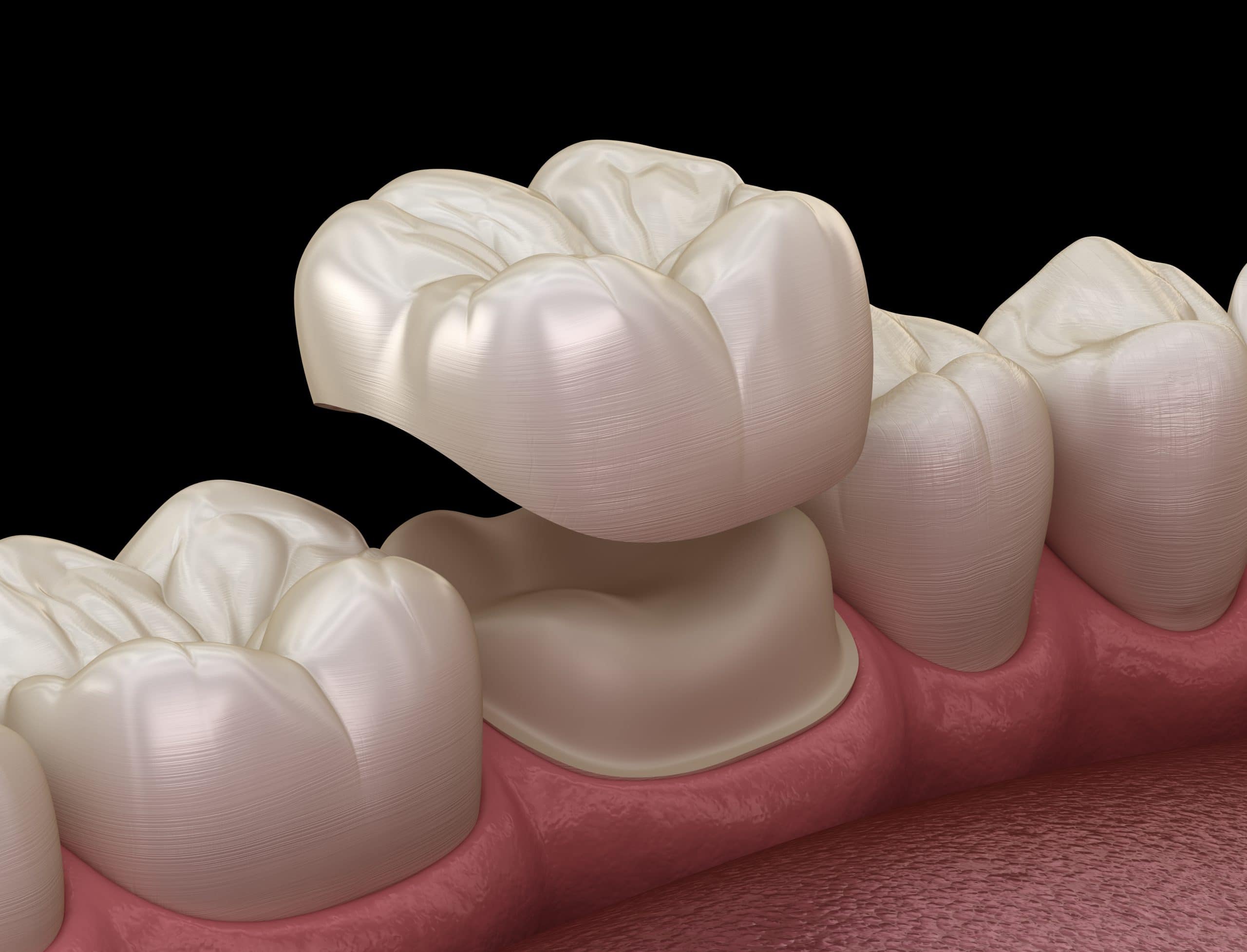 Vista Dental Crown