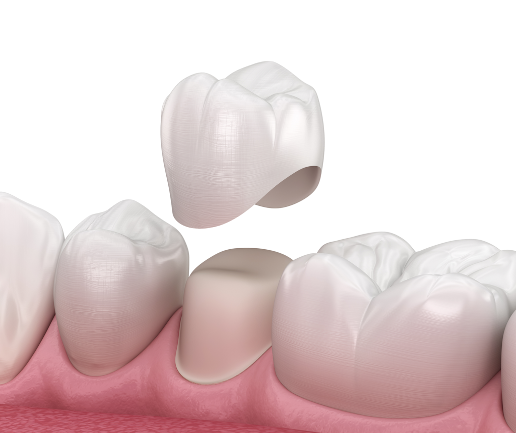 Carlsbad Dental Crown