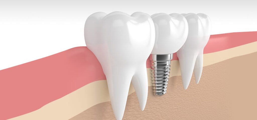 Carlsbad Dental Implants