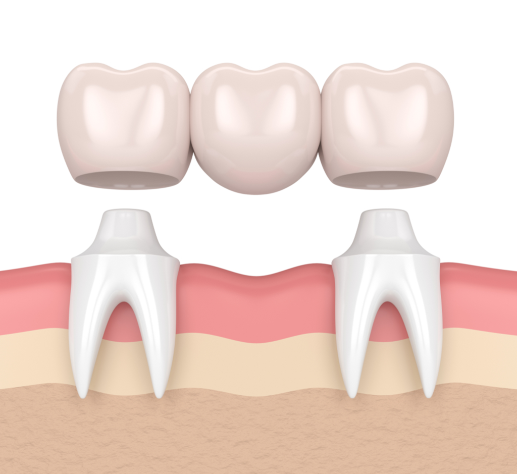 Oceanside Dental Bridge