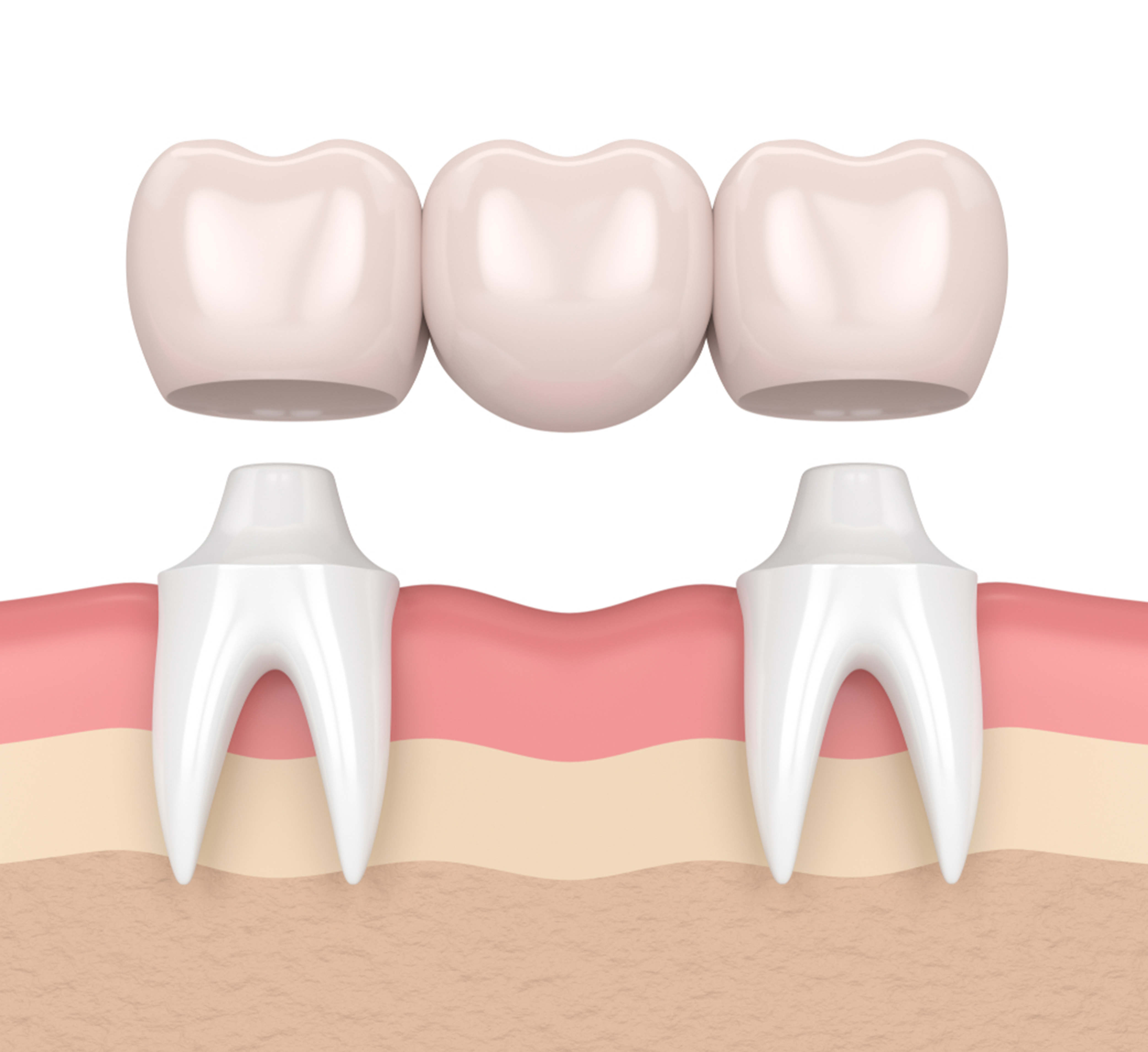 Oceanside Dental Bridge