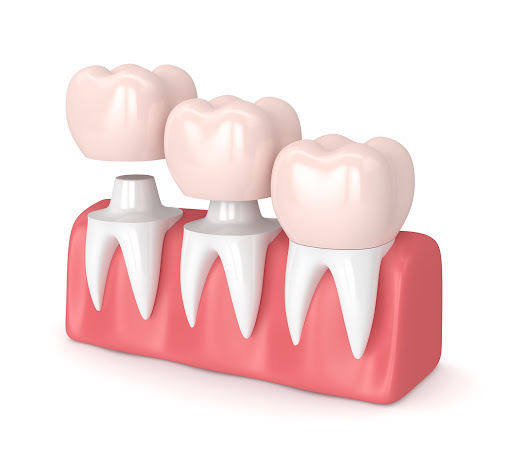 Carlsbad Dental Crown