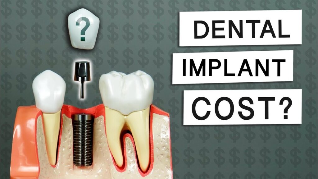 Carlsbad Dental Implant Cost