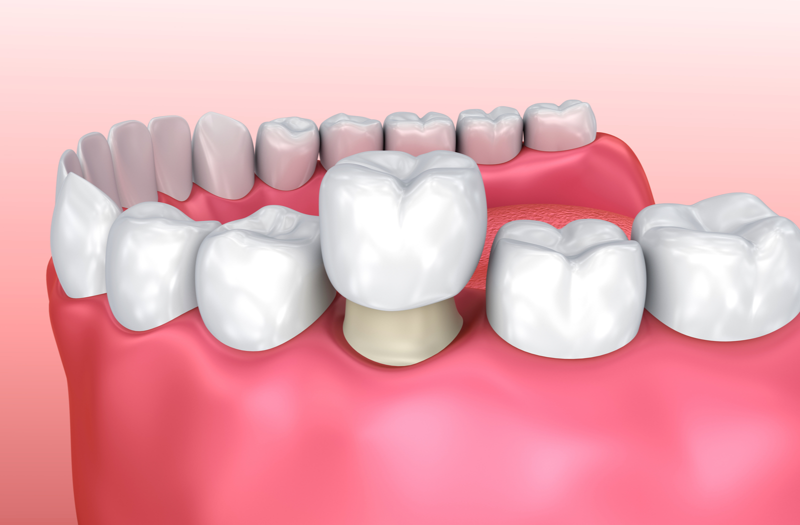 Vista Dental Crown