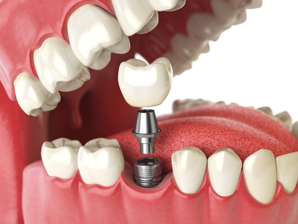 Vista Dental Implant Cost