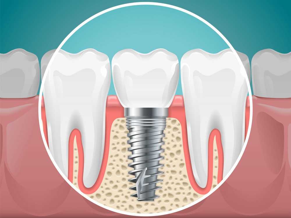 Vista Dental Implants