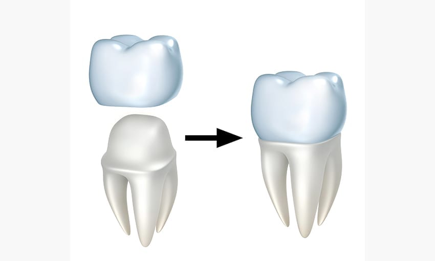 Oceanside Dental Crown