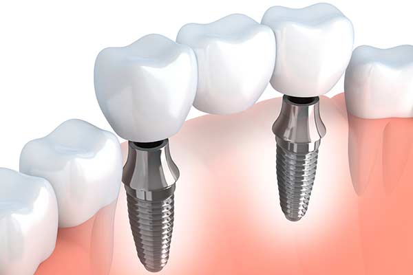 Oceanside Dental Implants