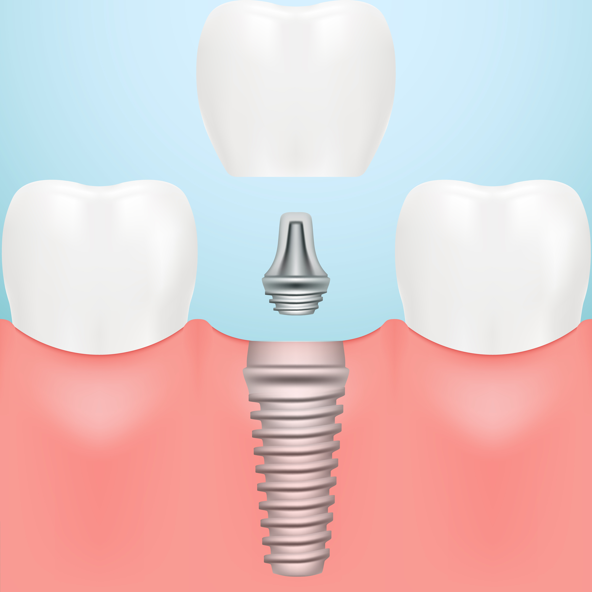 Oceanside Dental Implants Near Me