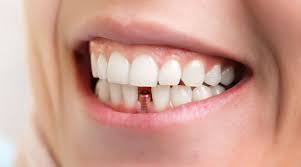 Carlsbad Dental Implants