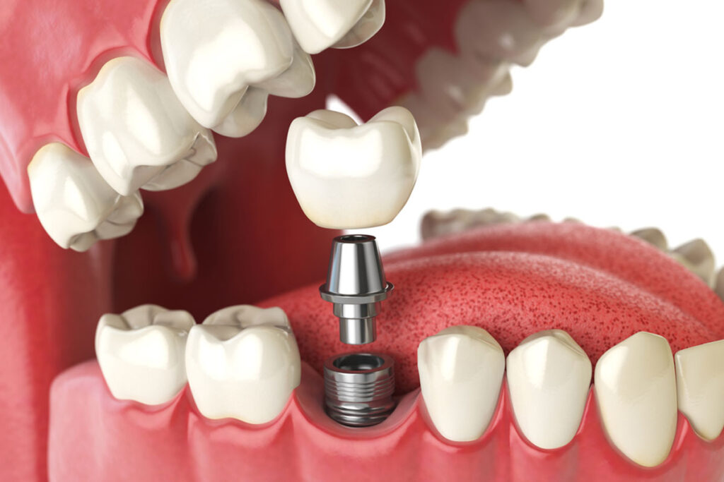 Dental Implant Cost Oceanside