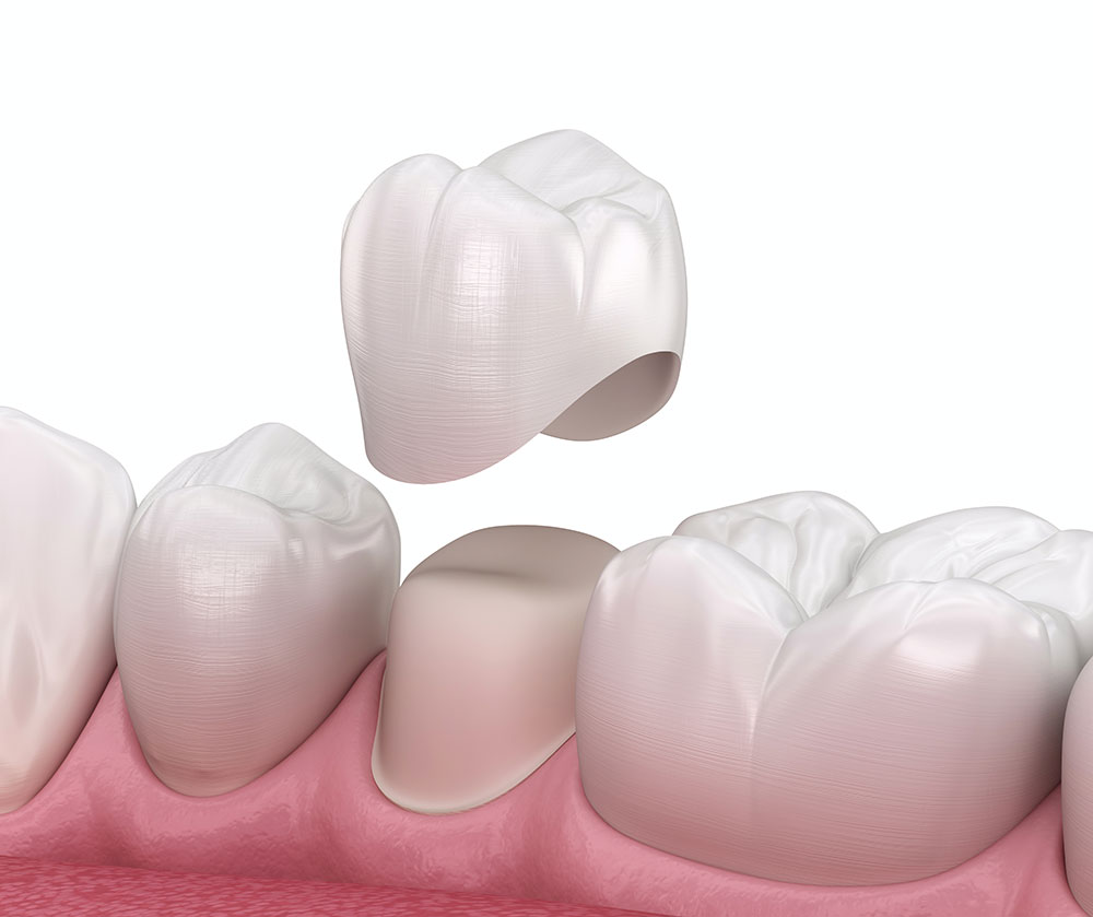 Vista Dental Crown