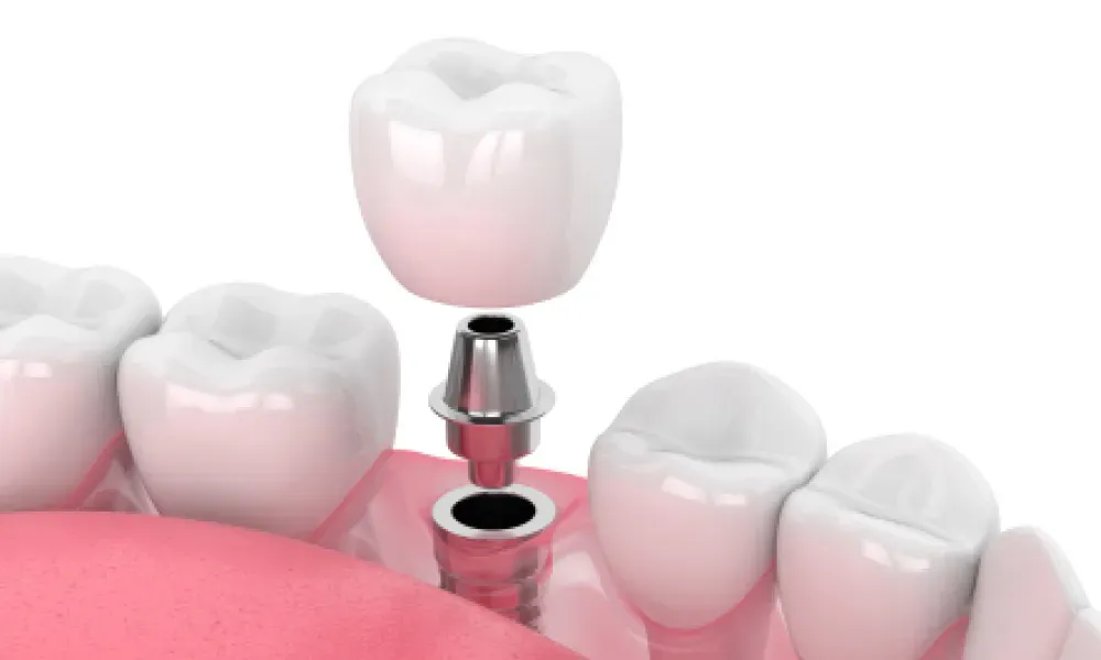 Vista Dental Implants