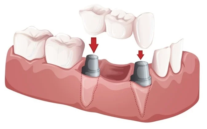 Carlsbad Dental Bridge