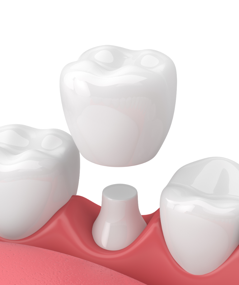 Carlsbad Dental Crown