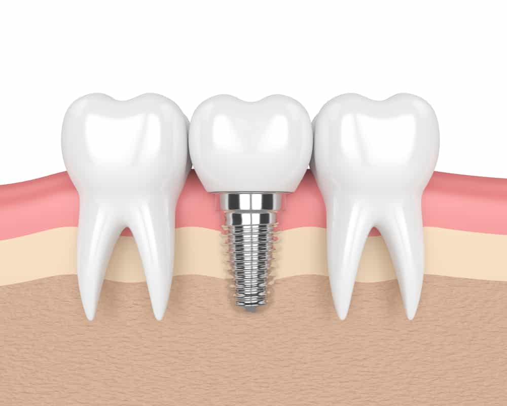 Carlsbad Dental Implant Cost