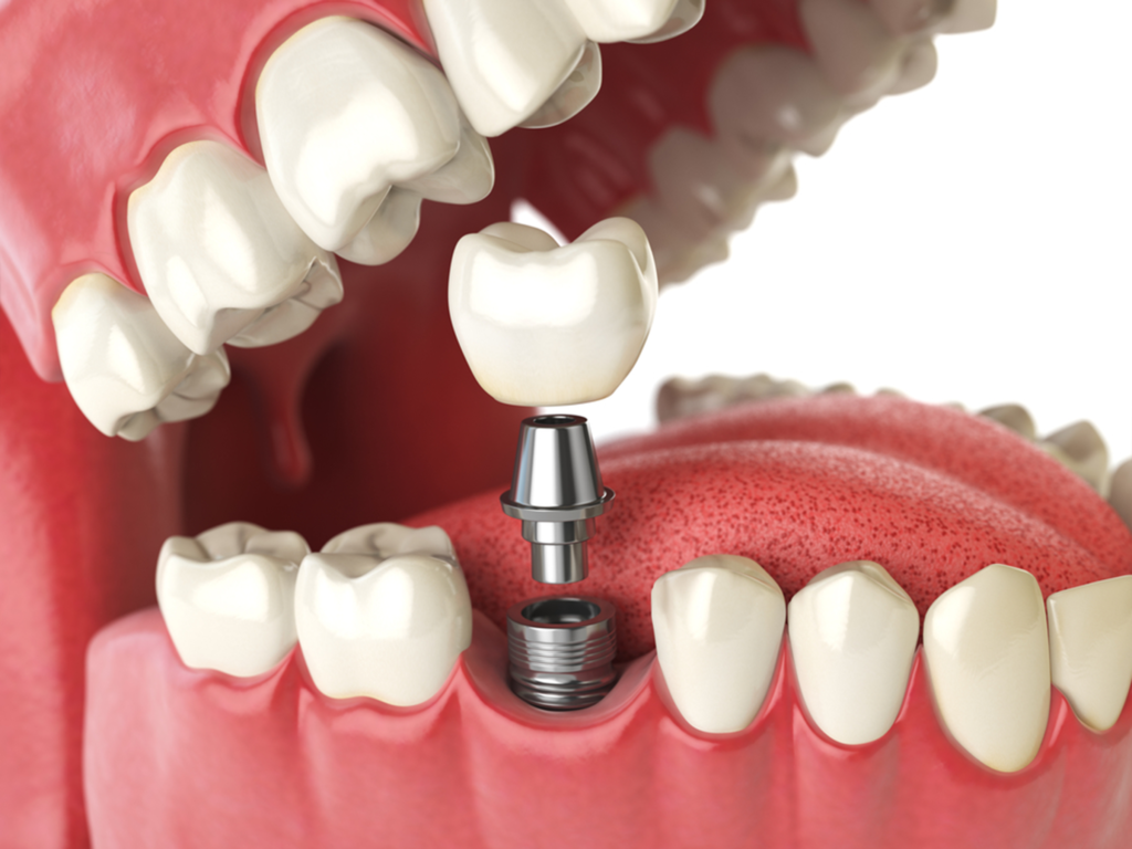 Dental Implant Cost Vista