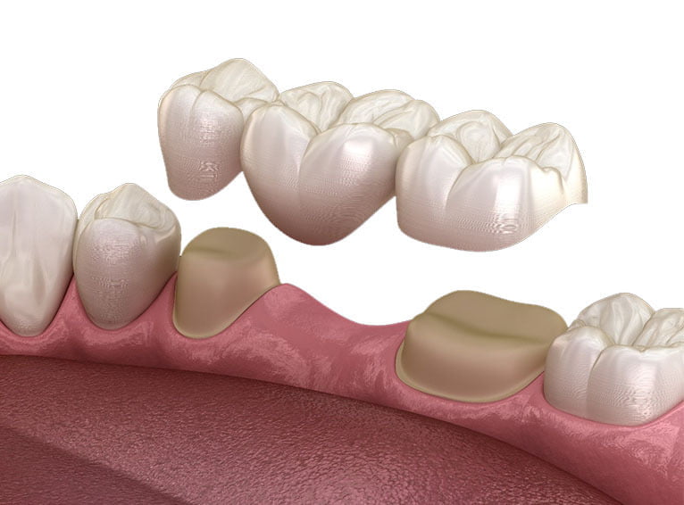 Vista Dental Bridge