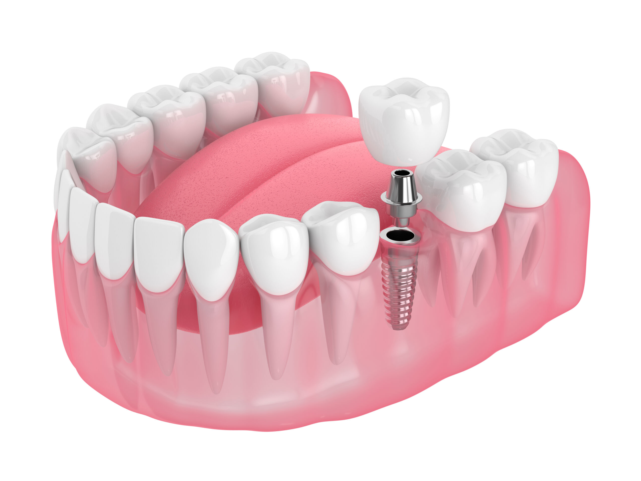 Oceanside Dental Implants