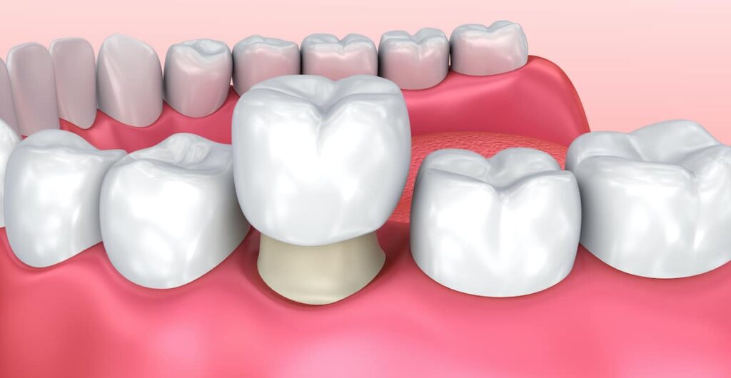 Dental Crown Vista