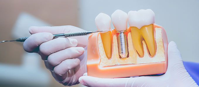 Dental Implant Cost Oceanside