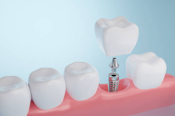 Dental Implants Carlsbad