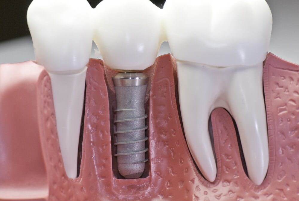 Dental Implants Near Me Vista