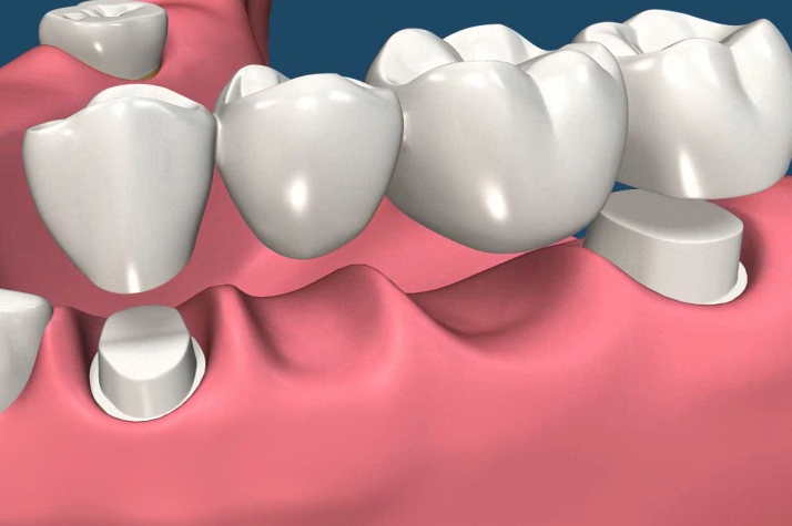 Dental Bridge Vista