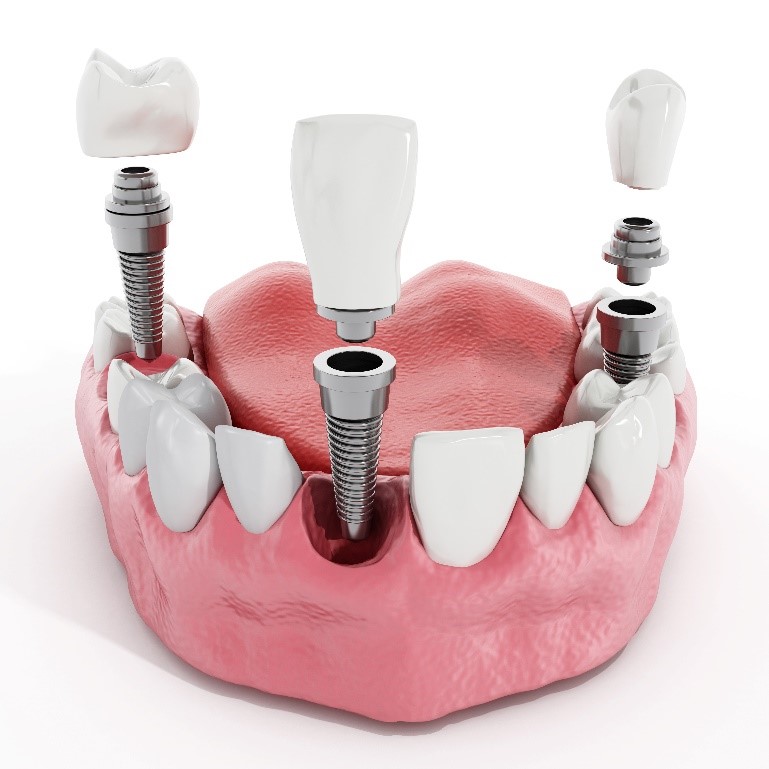 Dental Implants Near Me Carlsbad