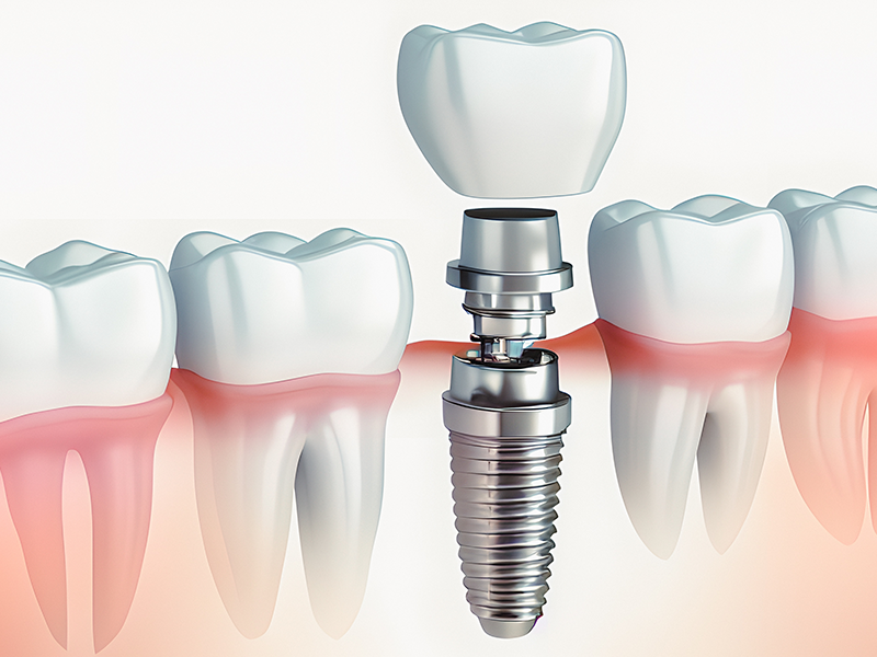 Dental Implants Oceanside