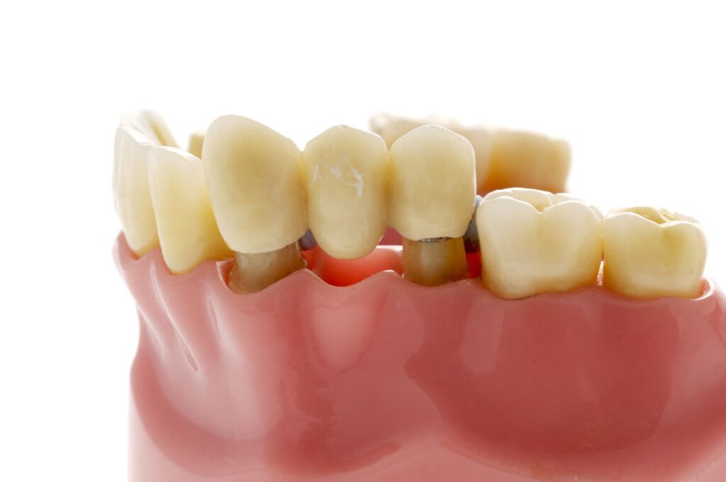 Dental Bridge Carlsbad