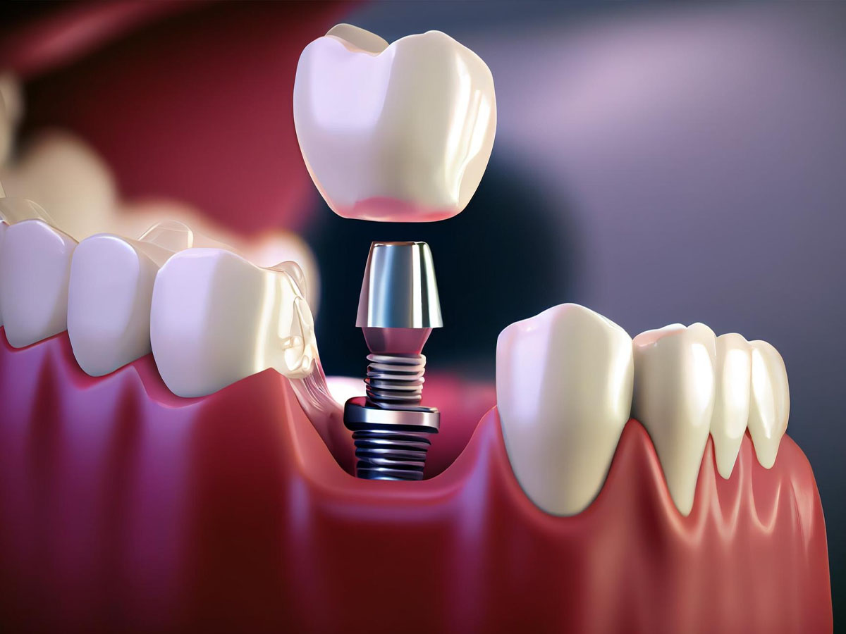 Dental Implants Near Me Oceanside