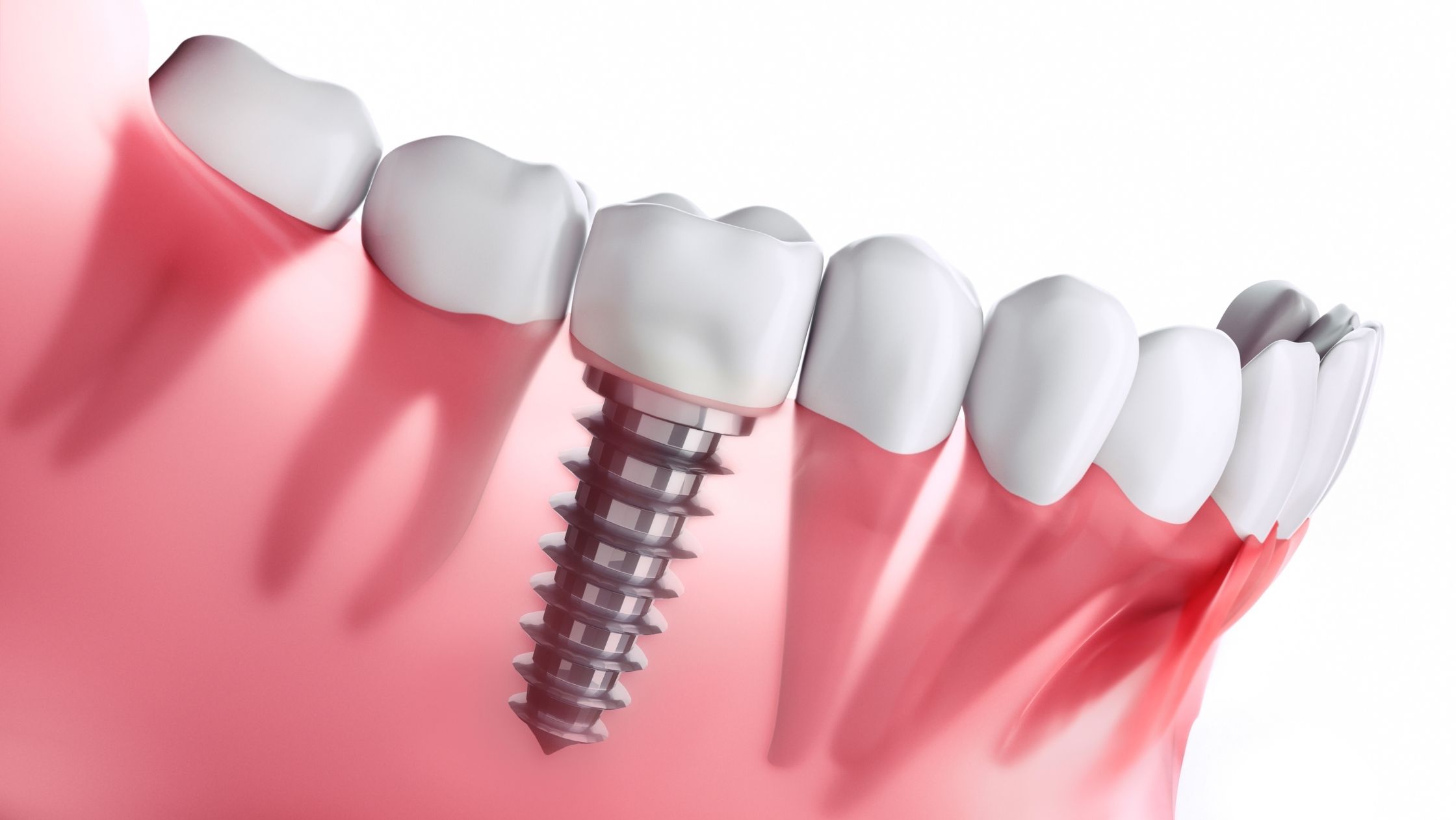 Dental Implants Vista