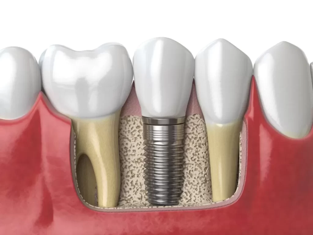 Dental Implants Near Me Vista