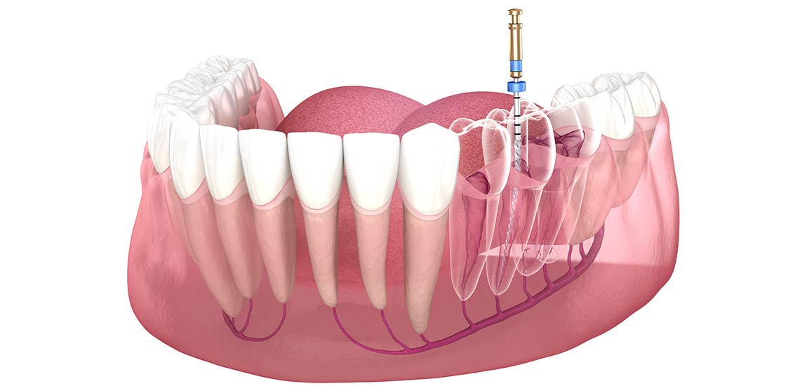 Endodontist Vista