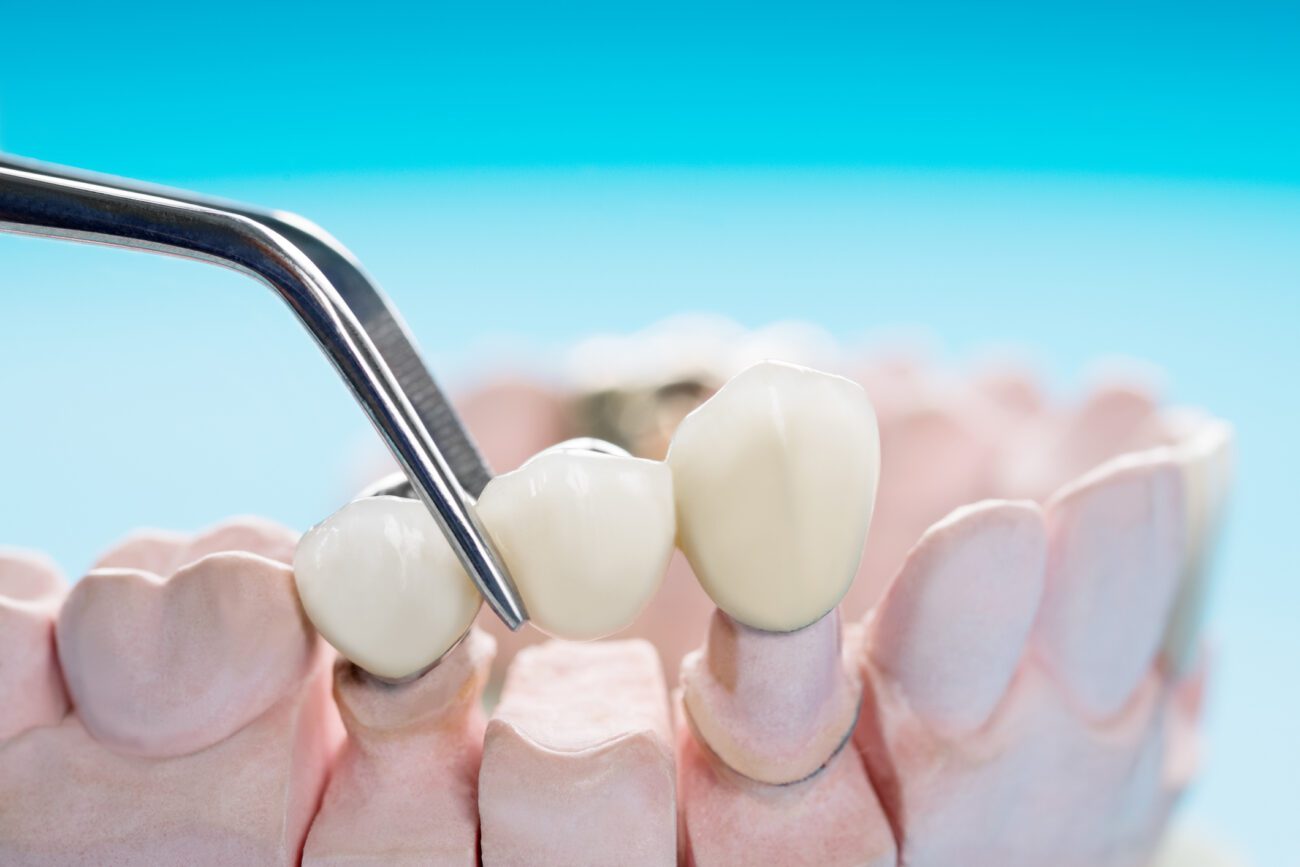 Dental Crown Oceanside