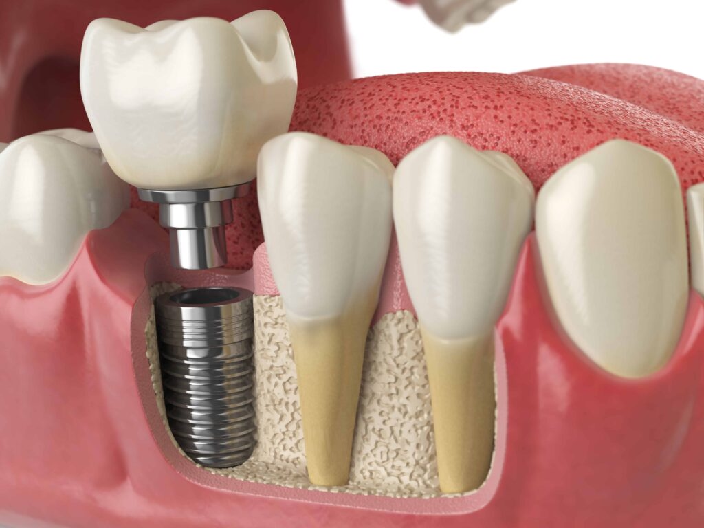 Dental Implant Cost Carlsbad