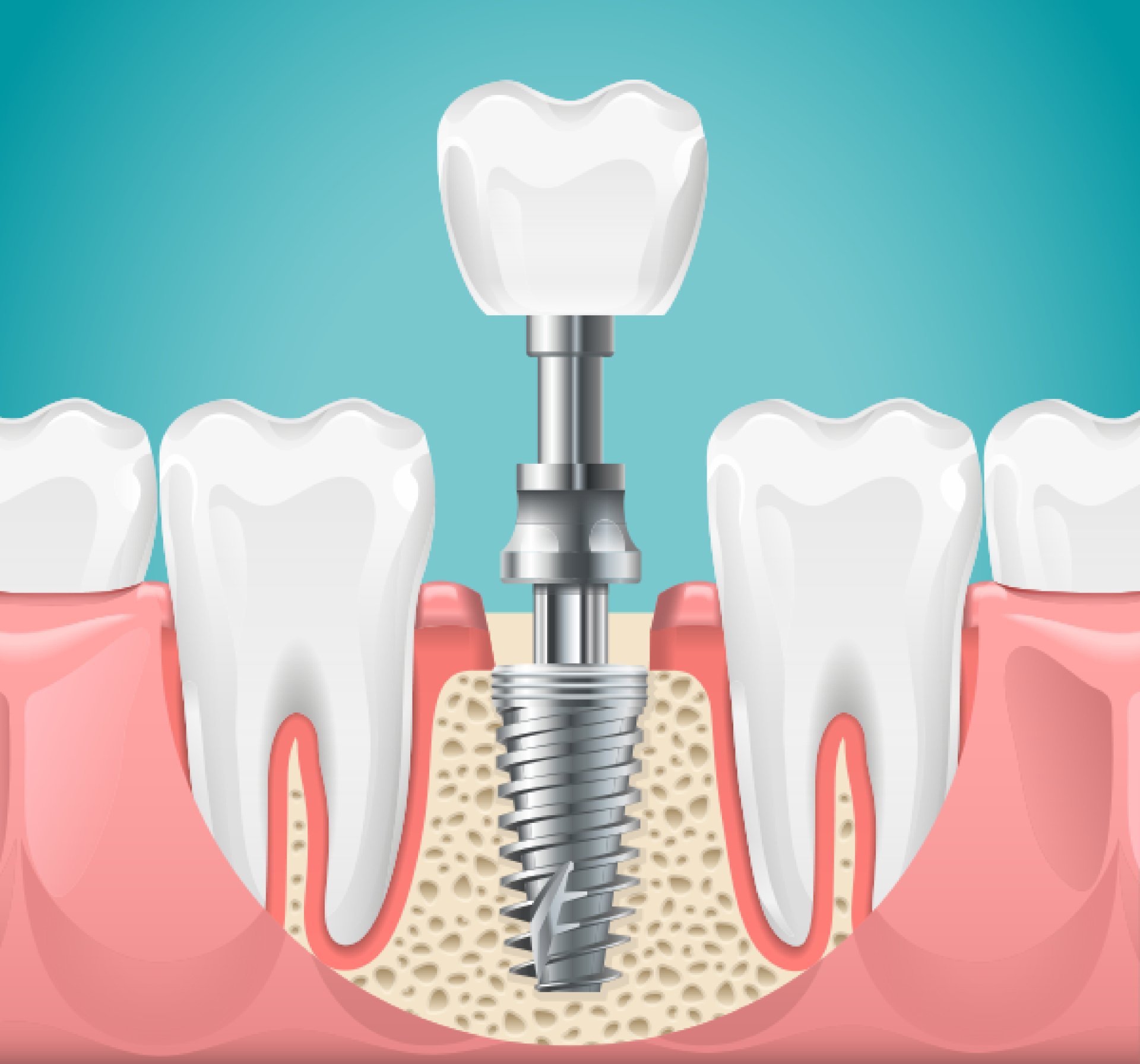 Dental Implant Cost Vista