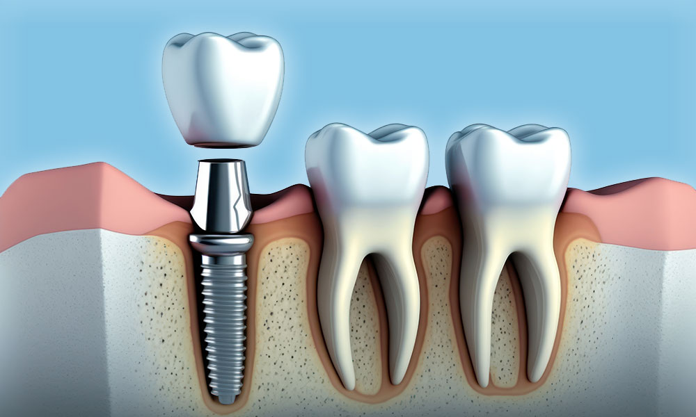 Dental Implants Near Me Carlsbad