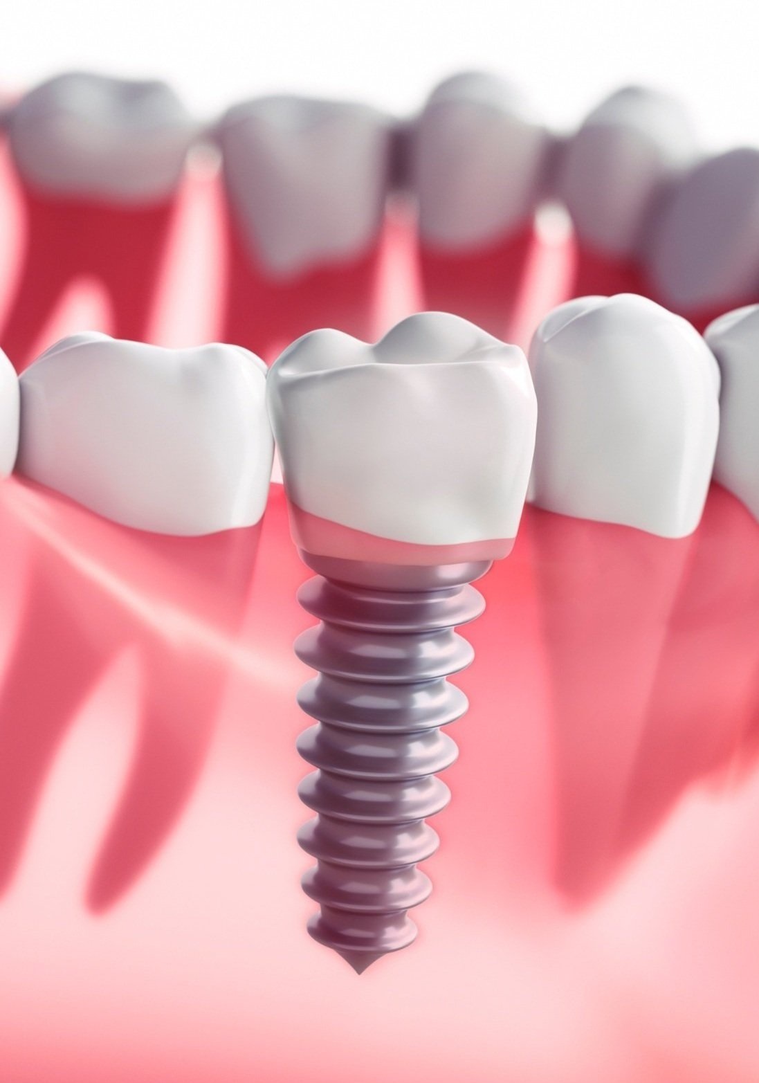 Dental Implants Oceanside