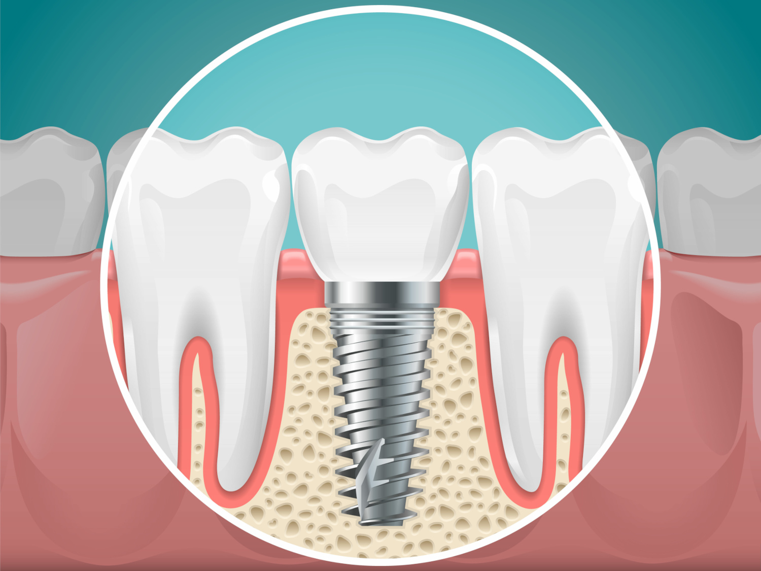 Dental Implant Cost Oceanside