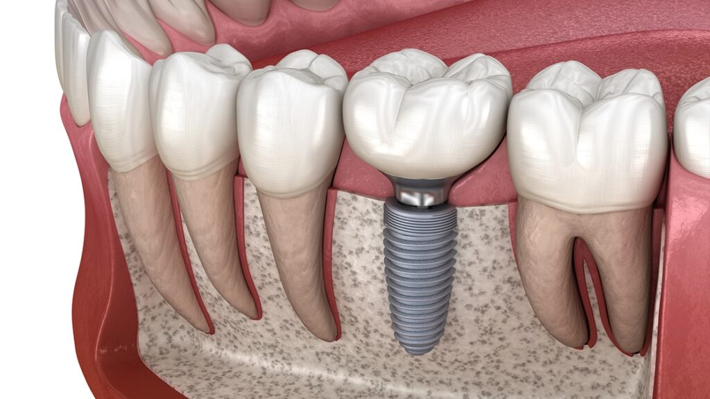 Dental Implants Near Me Oceanside