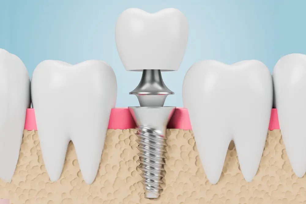 Dental Implants Vista