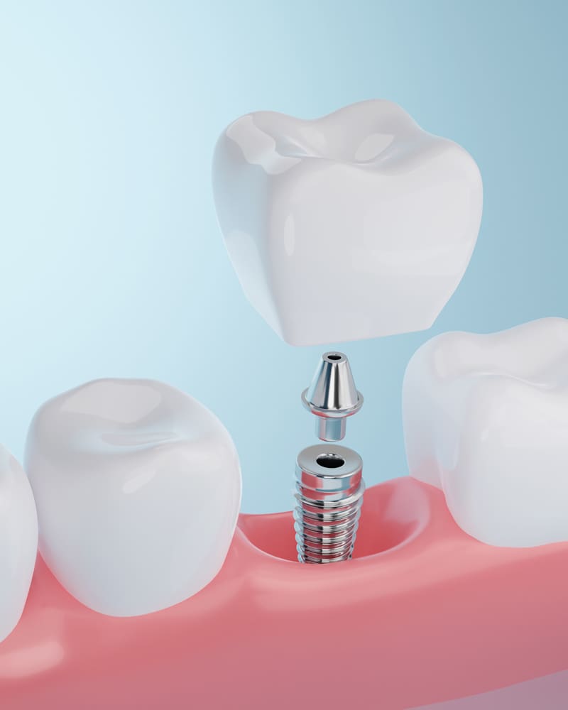 Dental Implants Near Me Carlsbad | Grace Dental