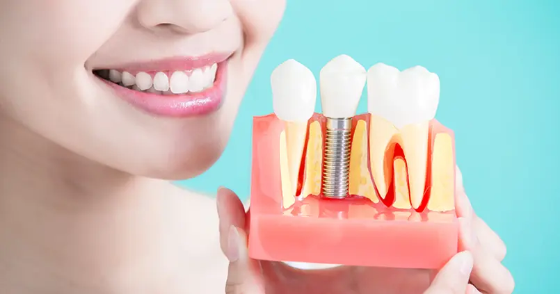 Dental Implants Near Me Oceanside