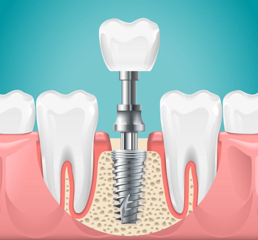 Dental Implants Oceanside