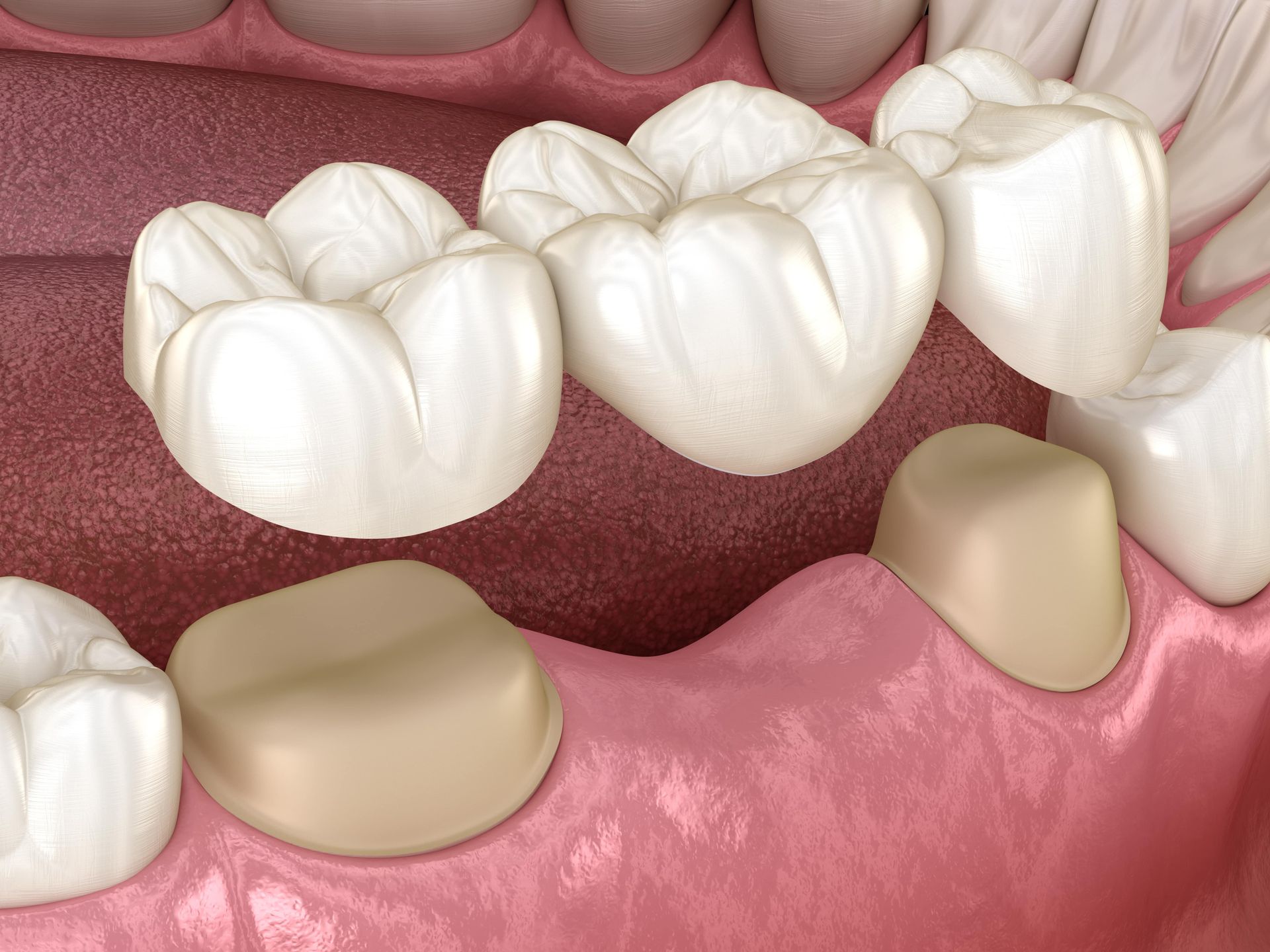 Dental Bridge Carlsbad